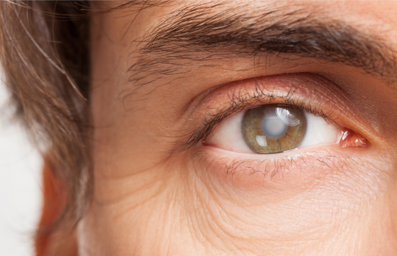 É verdade que o glaucoma não tem cura?