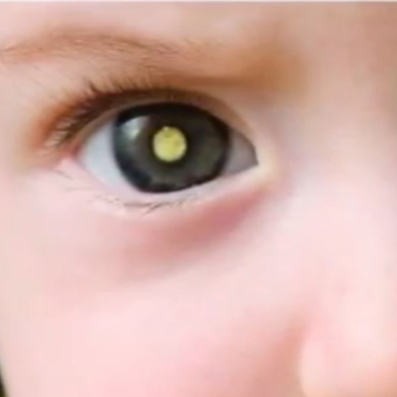 Retinoblastoma o que é e como tratar? - Dra. Mariana Gonçalves - Oftalmologista