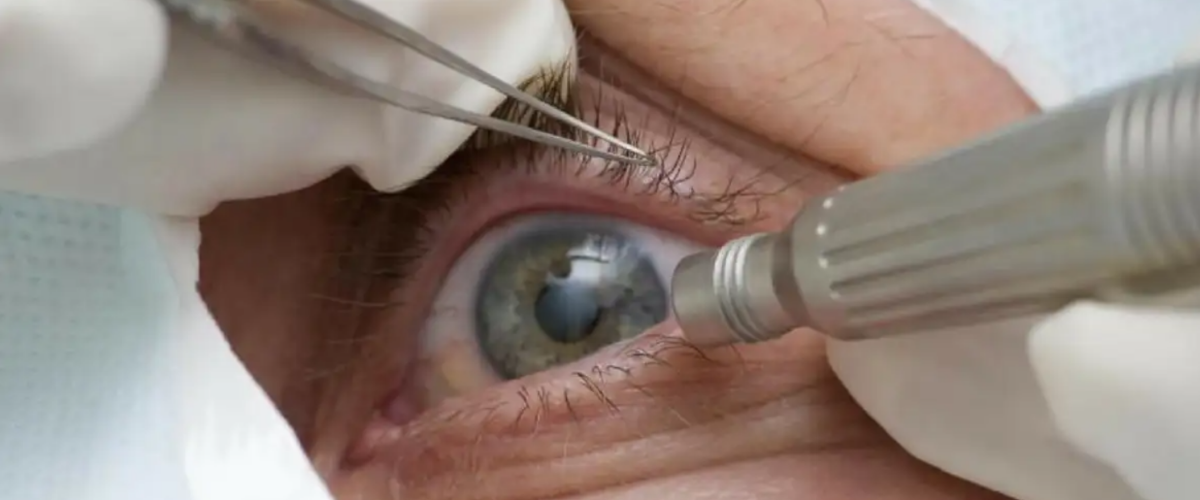 O CBO faz um alerta à população: mudar a cor dos olhos por meio de pigmentação da córnea é uma cirurgia de alto risco, com efeitos irreversíveis. Leia mais...