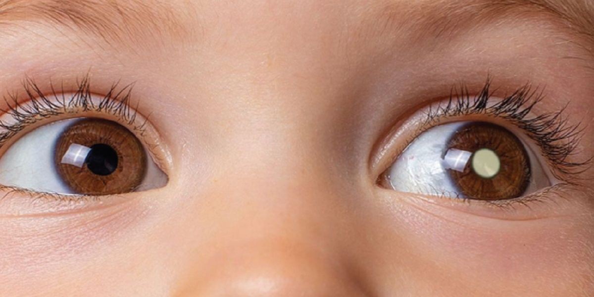 Campanha de conscientização sobre o retinoblastoma
Leia mais...